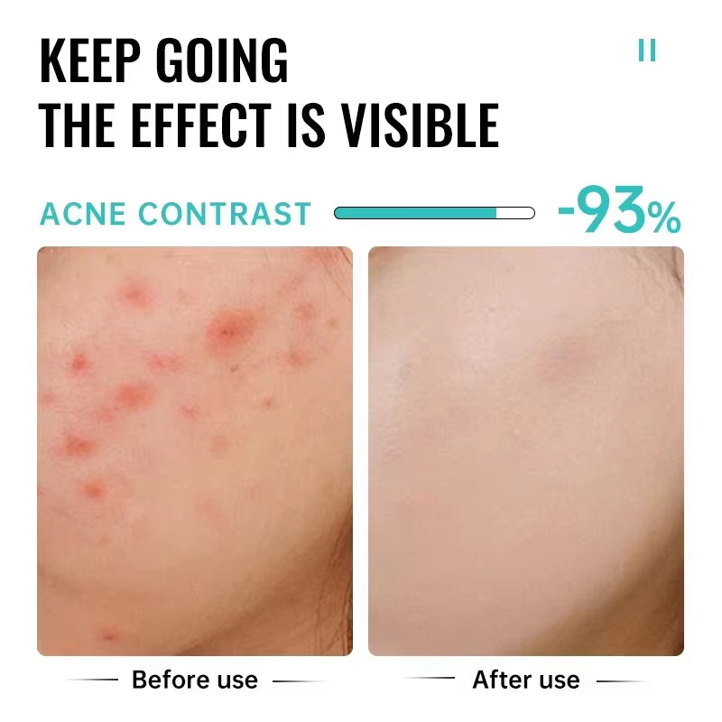Salicylic Acid Acne Treatment Face Cream Repair Pimple Spots Deep Cleaning Pore Anti-Acne Scar Oil Control Moisturizer Skin Care