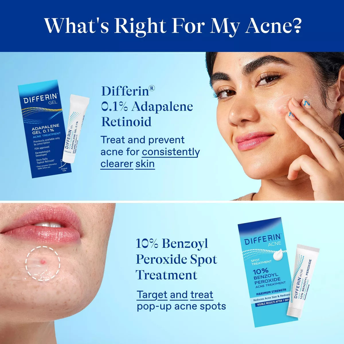 Differin 10% Benzoyl Peroxide Acne Spot Treatment: Hypoallergenic, Facial Treatment, Gel, Acne-Prone Skin