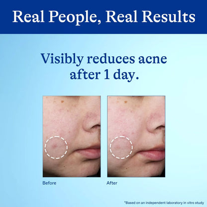 Differin 10% Benzoyl Peroxide Acne Spot Treatment: Hypoallergenic, Facial Treatment, Gel, Acne-Prone Skin